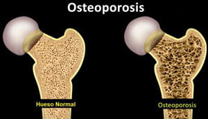 Osteoporosis